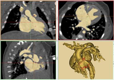 3D Printing in Surgical Management of Double Outlet Right Ventricle